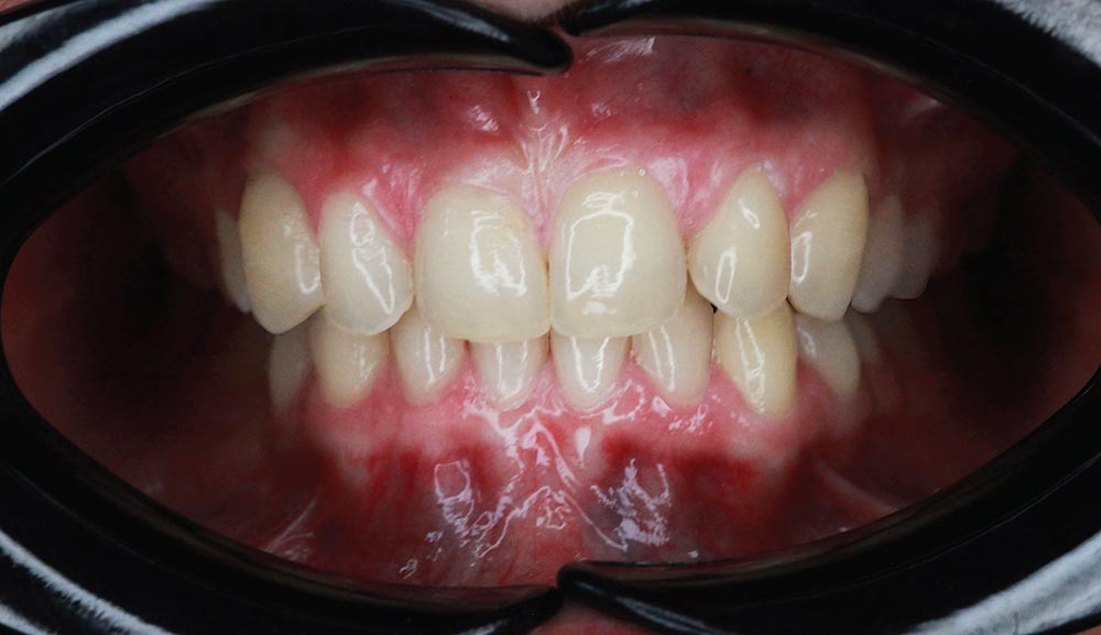 K-Clear Aligner After Photo