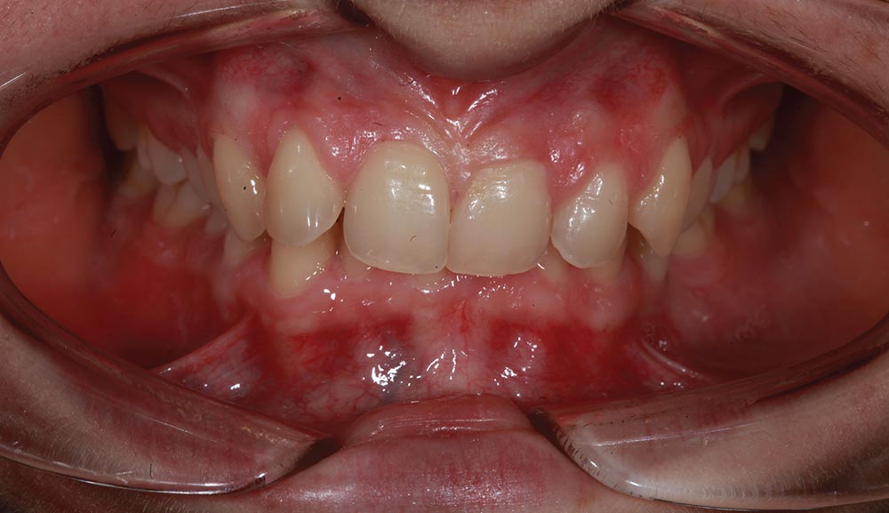 K-Clear Aligner Before Photo